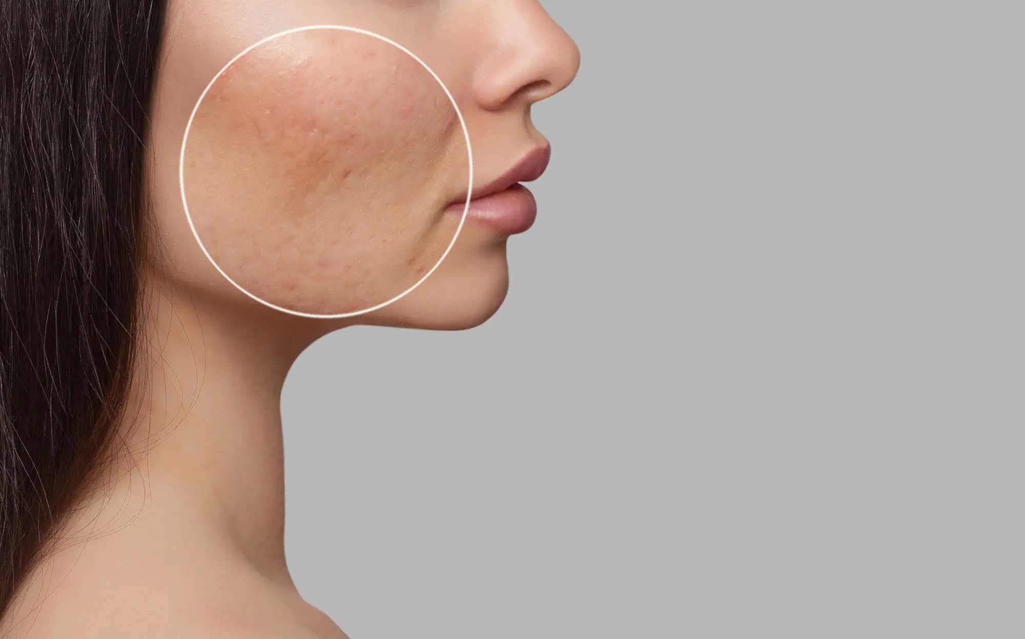 Acne Scarring/ Scars/ Stretch Marks Treatment in Southern Pines, NC