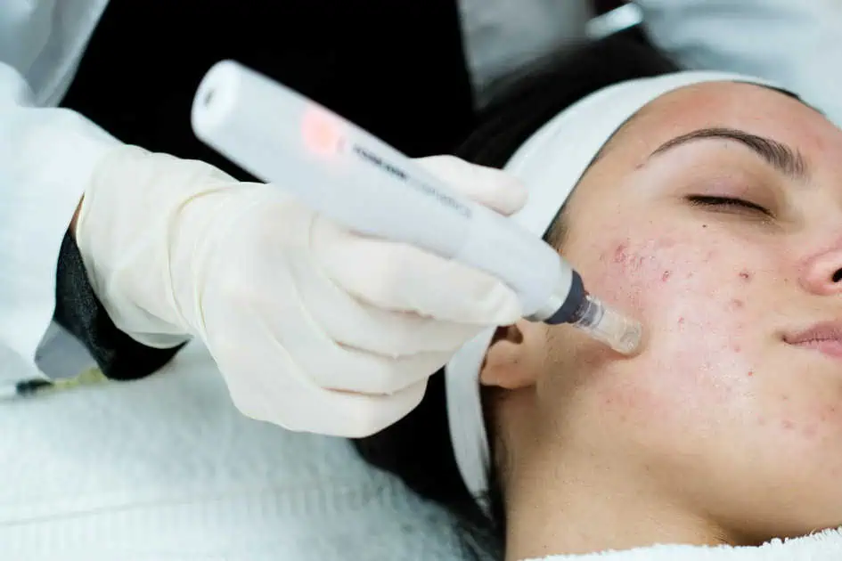 Microneedling with SkinPen® in Southern Pines, NC - Haven Wellness & Aesthetics