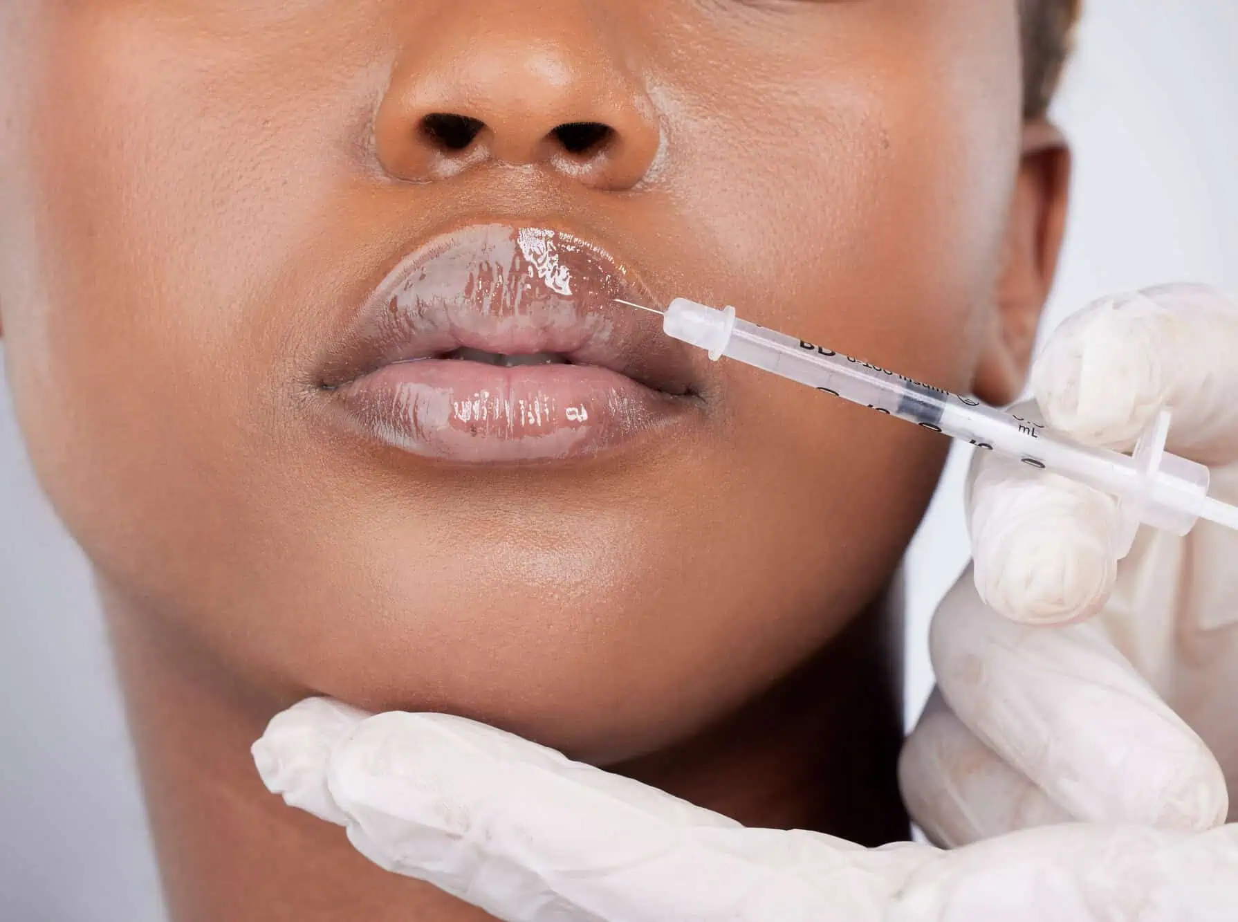 Dermal Fillers in Southern Pines, NC at Haven Skin Wellness